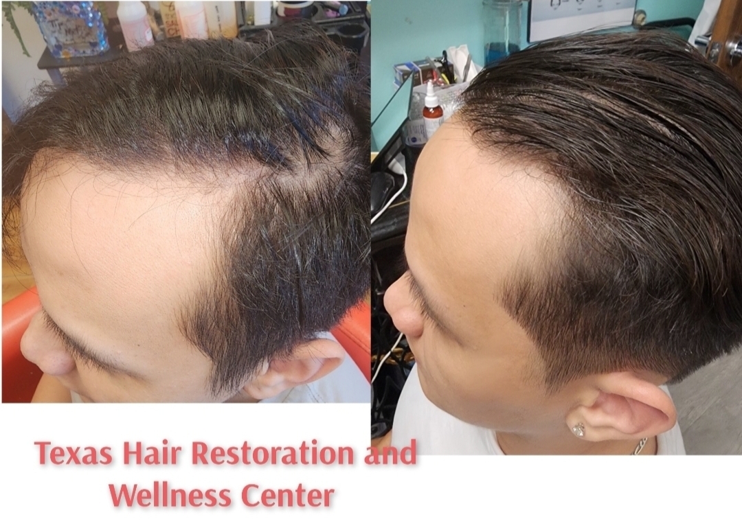 Approved client comparison: short hairstyle and temple photographed before on the left and after on the right.