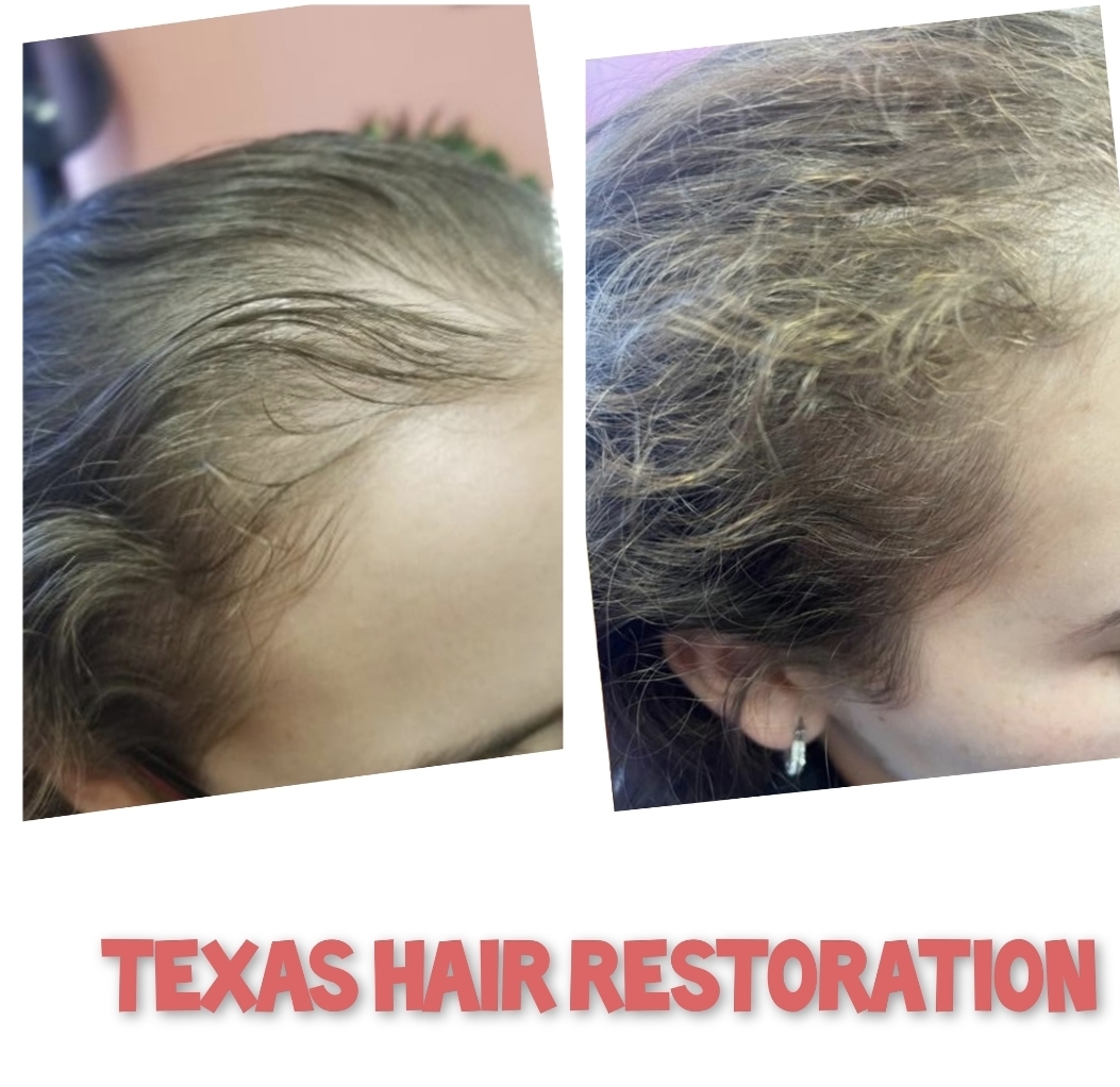 Approved client comparison: hairline photographed before on the left and after on the right.