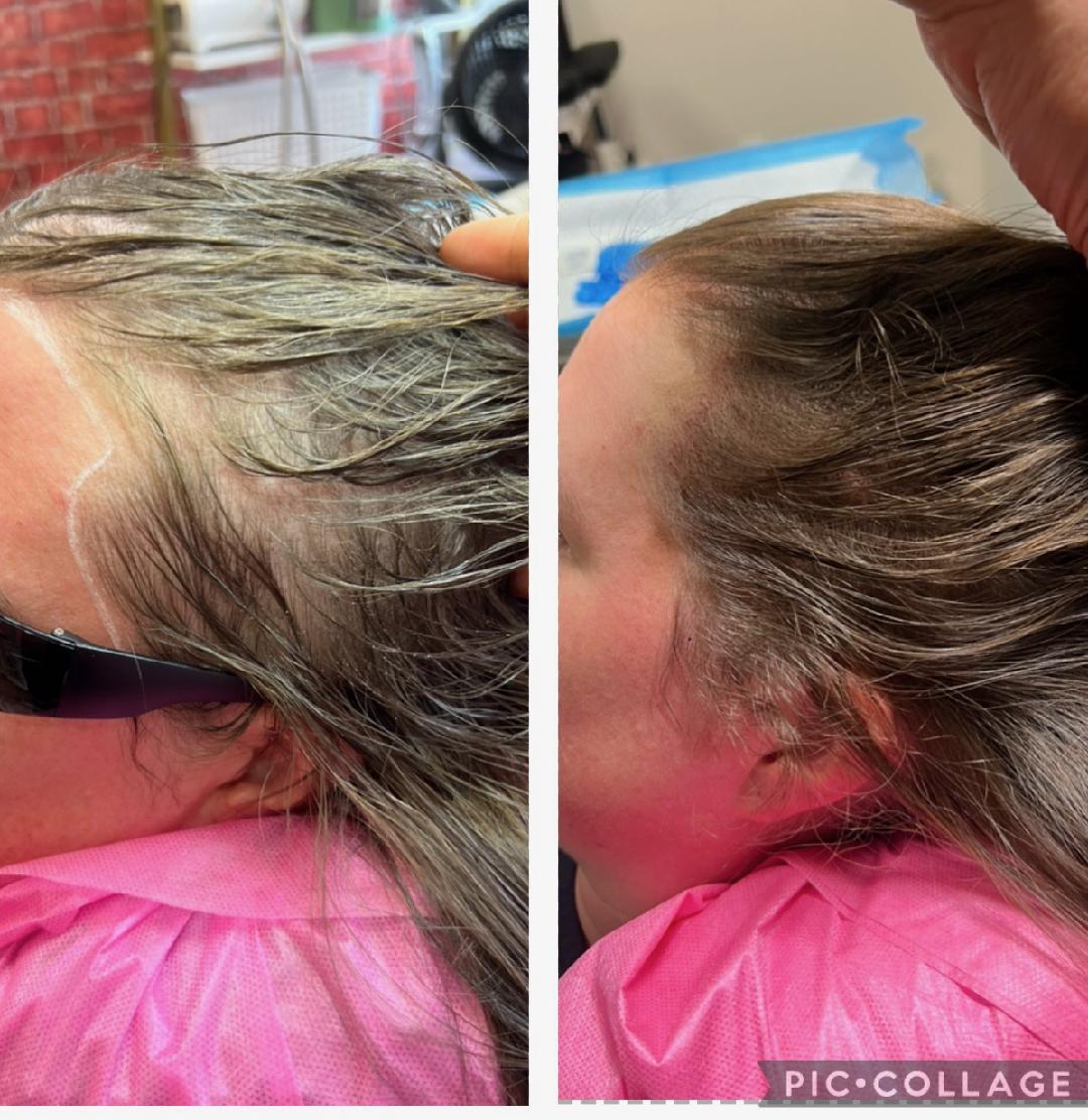 Approved client comparison: side hairline photographed before on the left and after on the right.